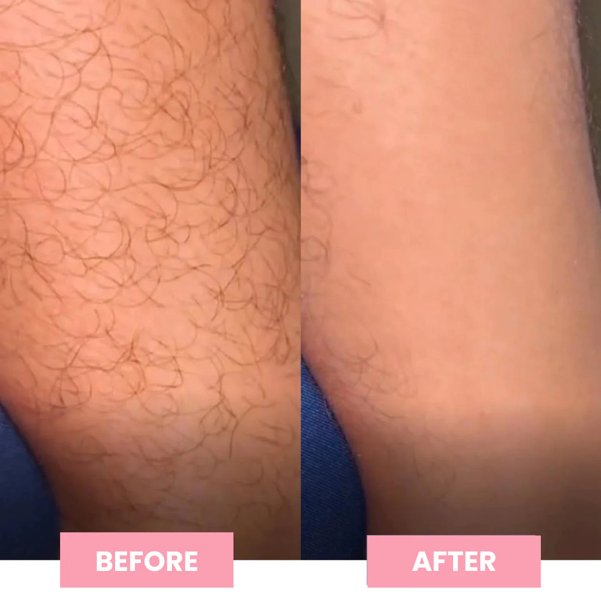 Crystal Hair Remover